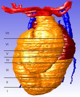 This overview indicates the division lines between the separate parts which make up the ventricle and outflow tract in the reconstruction; in the following figures these parts are shown separately to give an impression of the inside of the heart.